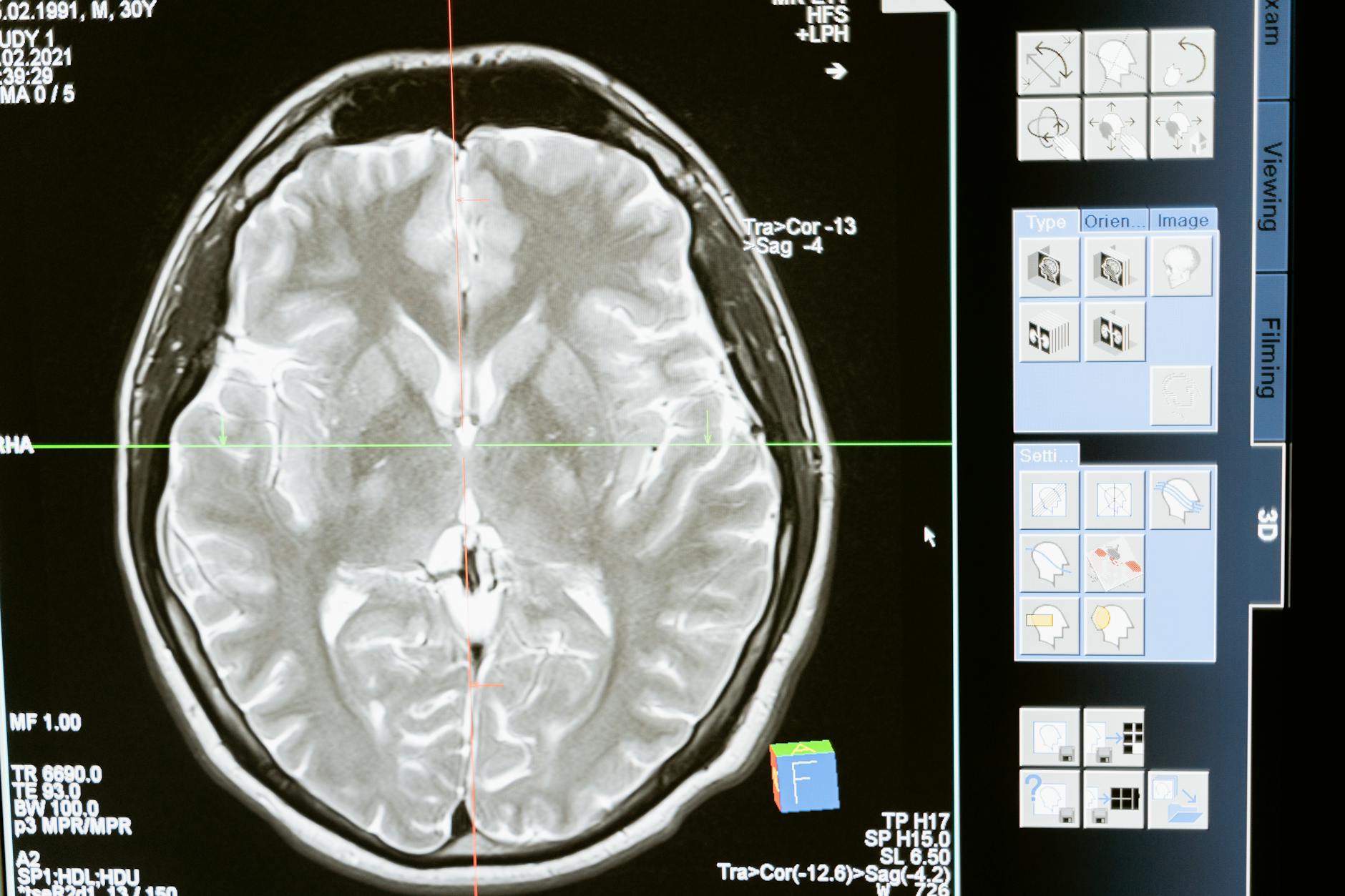 PET scan brain image using positron emission tomography, a medical technology that relies on antimatter annihilation