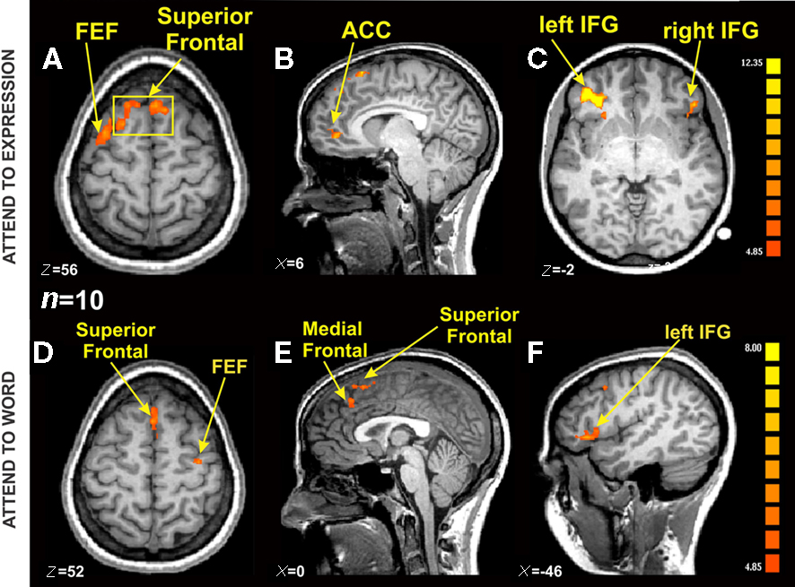 A functional MRI scan of brain activity, used to assess disorders of consciousness.