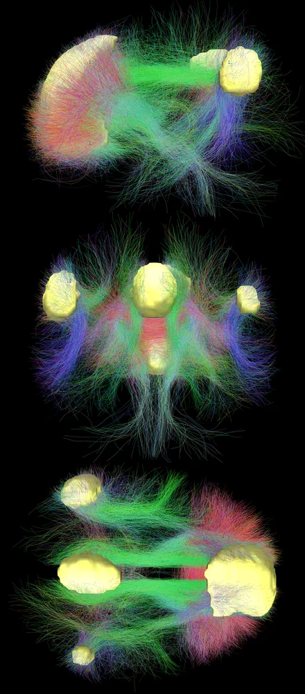 Brain imaging of the default mode network