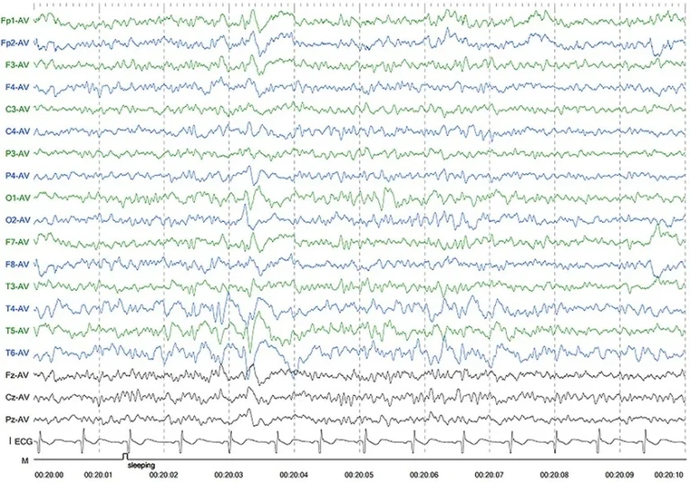 A person undergoing an EEG recording