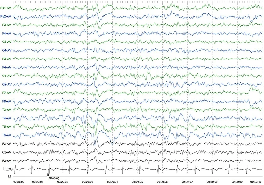 Disorders of Consciousness: When the Brain Is Aware But Cannot Show It