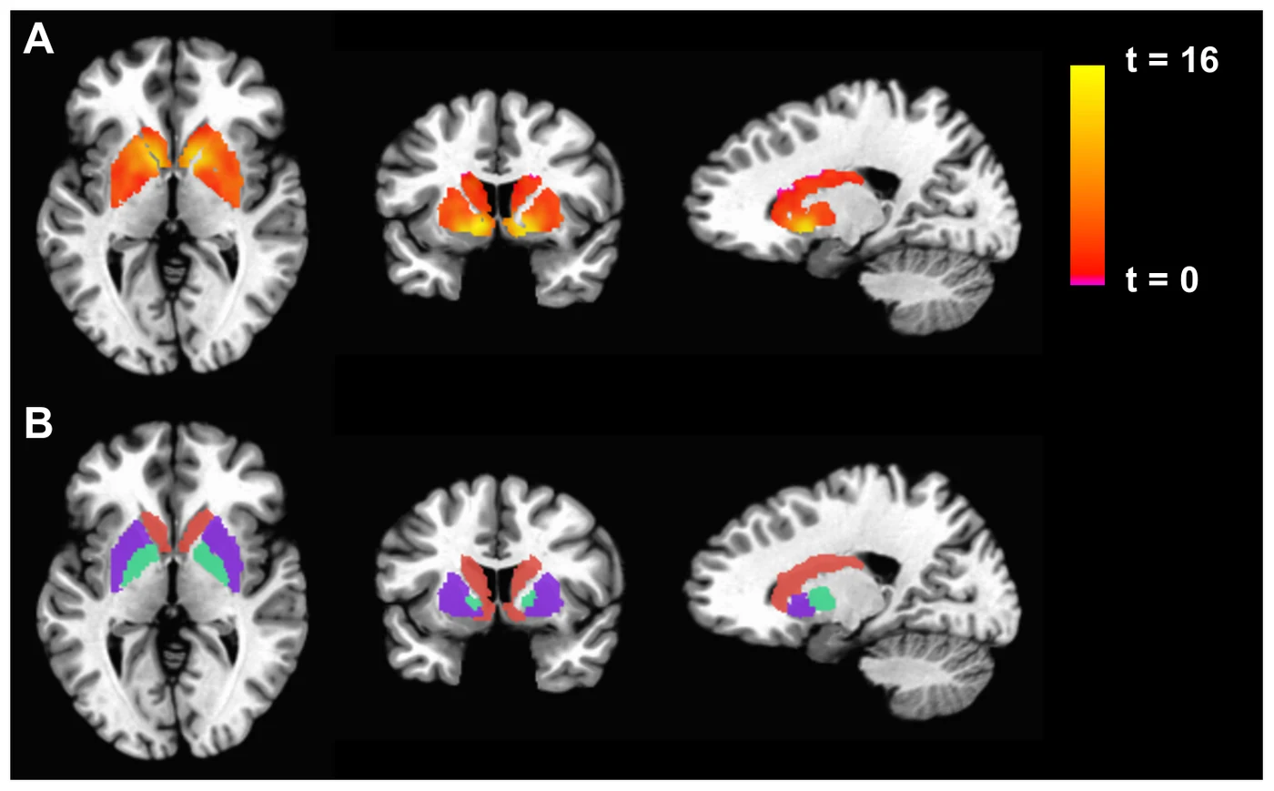 Functional MRI scans showing activation in the basal ganglia, an example of the brain imaging used to identify neural correlates of consciousness