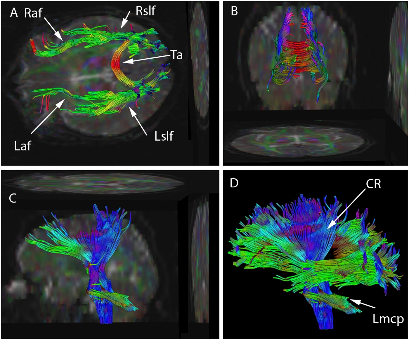 Diffusion tensor imaging tractography showing white-matter fibre bundles connecting regions of the human brain